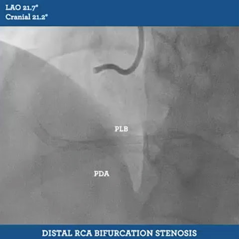 Distal RCA Bifurcation Stenosis